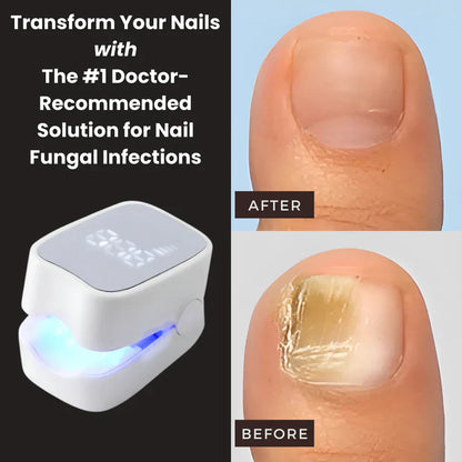 ultrapick™ - Nail Fungus Laser Device